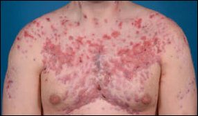 Anabolic steroids acne