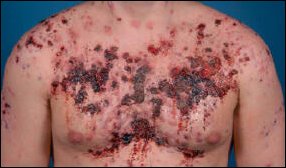 Severe acne after steroids