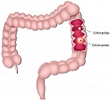 How sugars in soft drinks stimulate colon cancer
