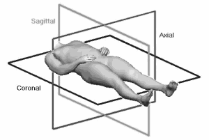 Myositis ossificans found in steroids user's delts