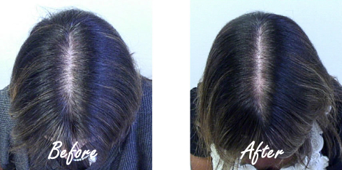 Combination of fish oil and GLA stimulates hair growth