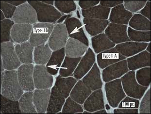 Oxandrolone can reverse effects of muscle disease