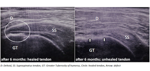 This dose of vitamin C accelerates the healing of a torn rotator cuff